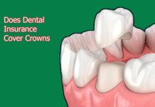 Does Dental Insurance Cover Crowns Does Dental Insurance Cover Crowns