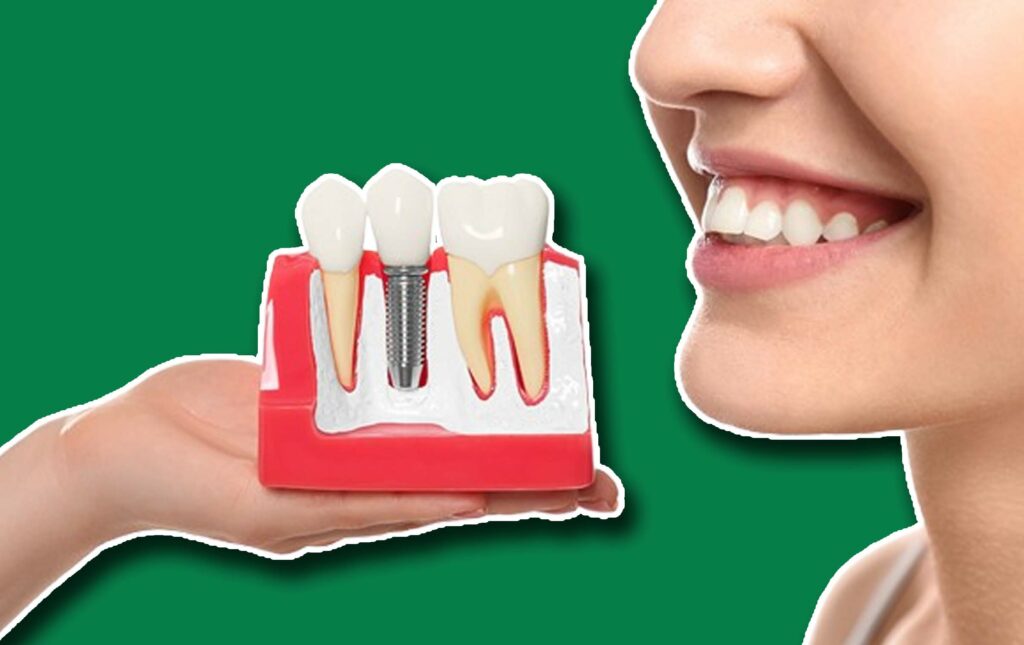 How To Get Dental Implants Covered By Insurance