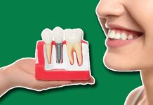 How To Get Dental Implants Covered By Insurance How To Get Dental Implants Covered By Insurance