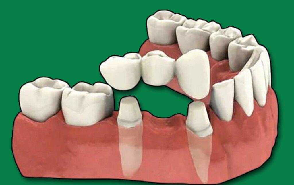 Does Dental Insurance Cover Sealants