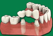 Does Dental Insurance Cover Sealants Does Dental Insurance Cover Sealants